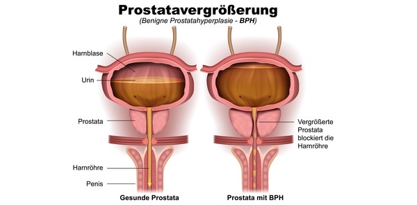 Grafik einer normalen Prostata (Vorsteherdrüse) und einer Prostata mit BPH.