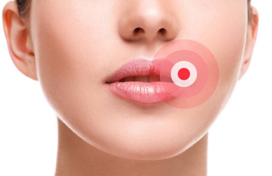 Besonders verbreitet ist der Lippenherpes, der sich durch unangenehme Bläschen im Mundbereich bemerkbar macht.