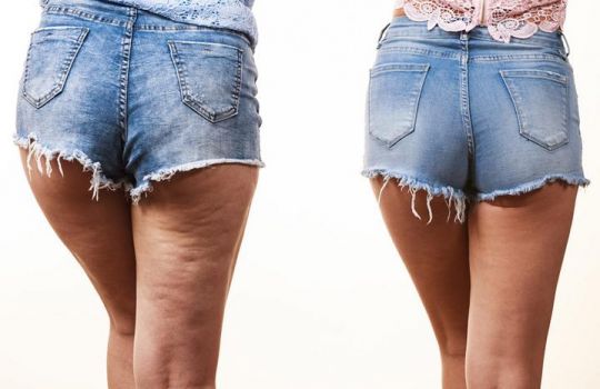 Beine von hinten im Vergleich: links Frau mit Cellulite, rechts Frau mit straffen Beinen.
